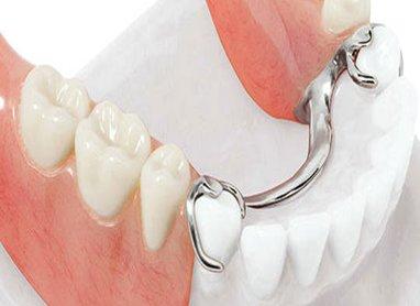 Meilleures prothèses dentaires en 2026