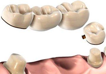 Meilleures prothèses dentaires en 2026